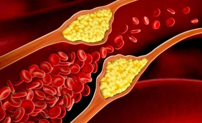 Kolesterol nedir? Kolesterol nasıl düşürülür?